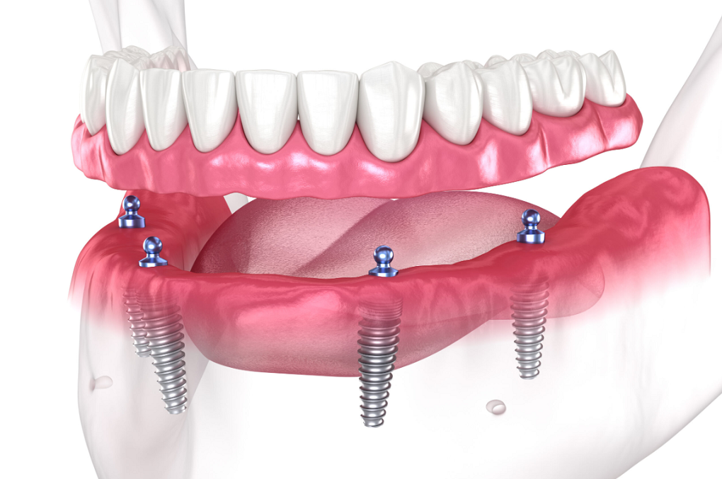 Dental Implants